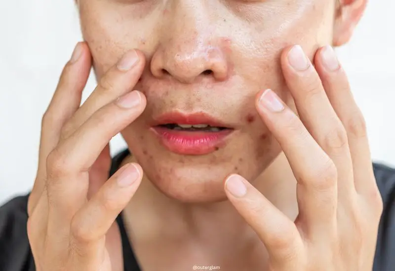 Close up of worried woman having problems of oily skin with acne inflamed on her face